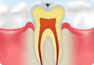 CO 初期段階のむし歯