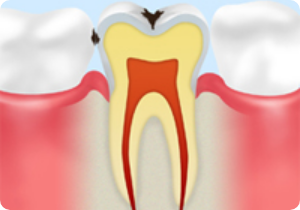 C1　エナメル質が溶けた状態のむし歯