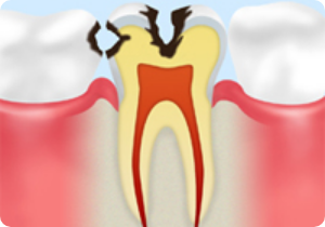 C2　象牙質まで達したむし歯